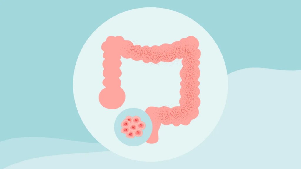 8 Colon Cancer Myths Debunked: Prevention and Early Detection Tips