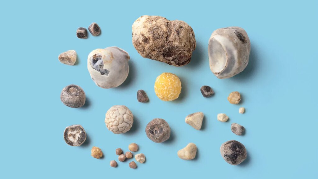 What to Know About Gallstones When You Have Crohn’s Disease