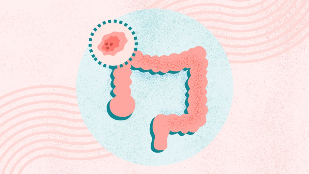 Colon and Rectal Cancer: Your Guide to Symptoms, Treatment, Prevention, and More