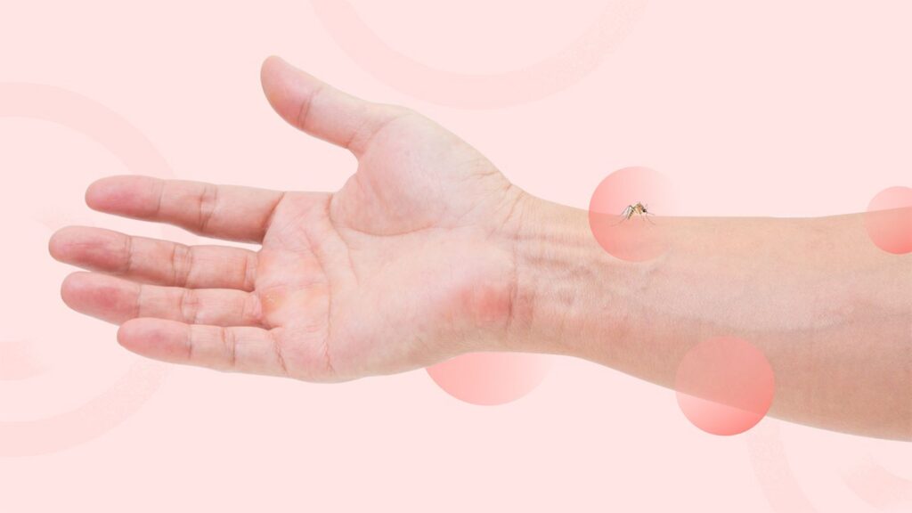 Are You a Mosquito Magnet? Here’s Why and What to Do About It