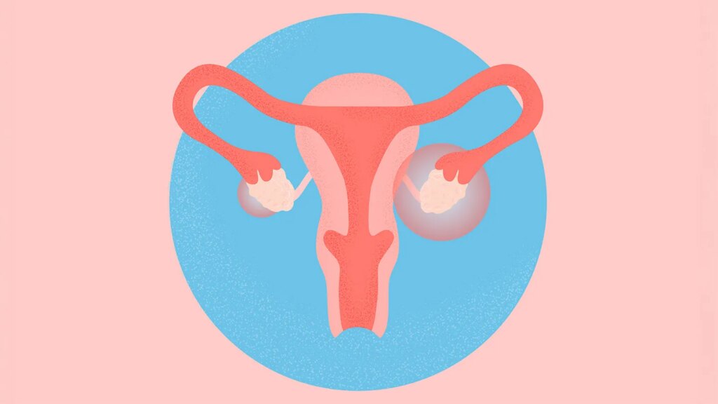 What Is Polyendocrine Metabolic Ovarian Syndrome (PMOS), Formerly Known as PCOS? Symptoms, Causes, Diagnosis, and Treatment