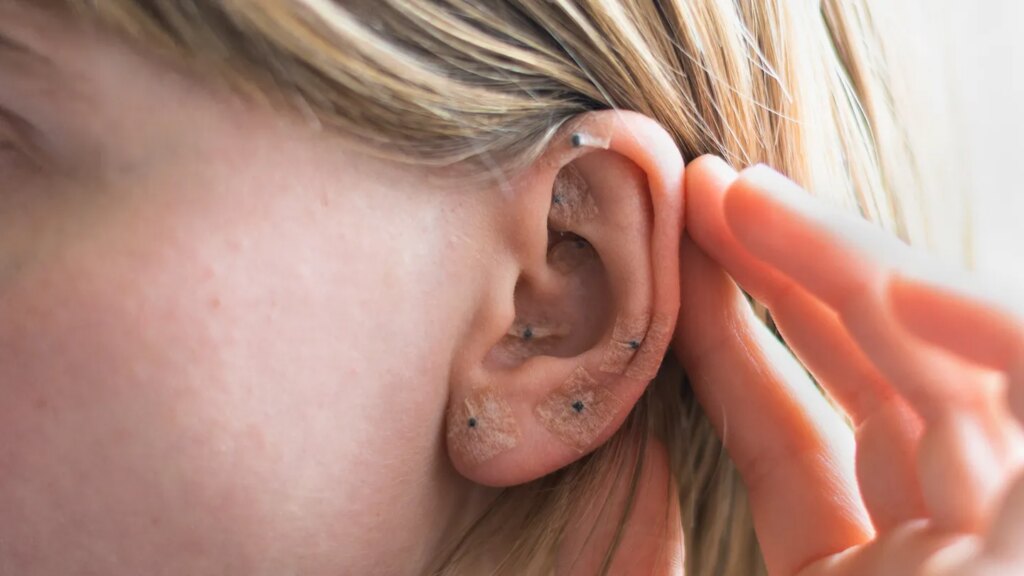 Ear Seeds: An Acupressure Technique for Wellness
