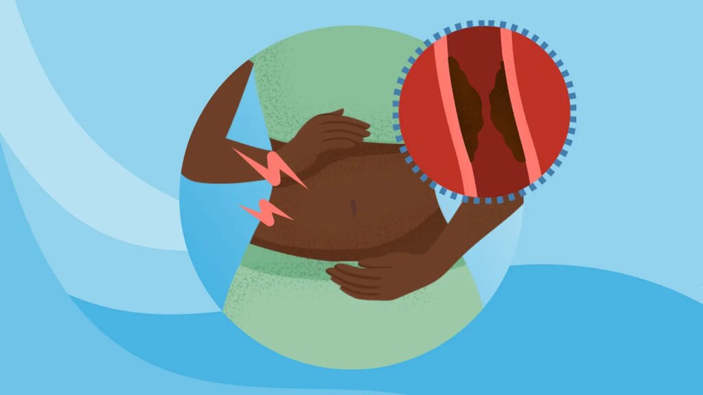 What Is Fecal Impaction? Symptoms, Causes, Diagnosis, Treatment, and Prevention